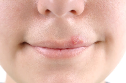 Чем лечить герпес на губах у детей 3 года